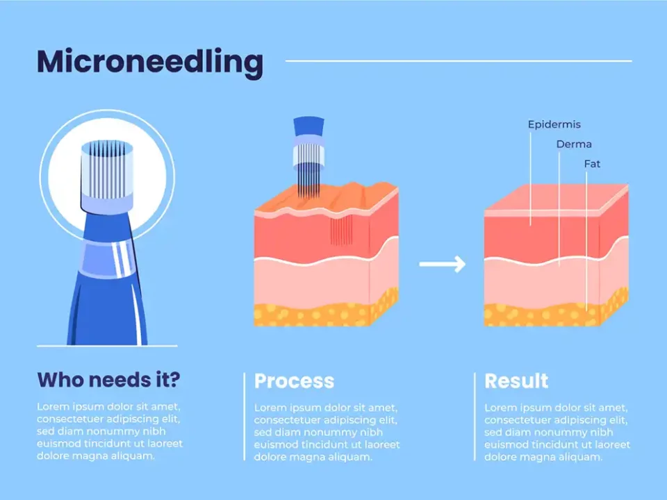 Microchannelling-vs-Microneedling
