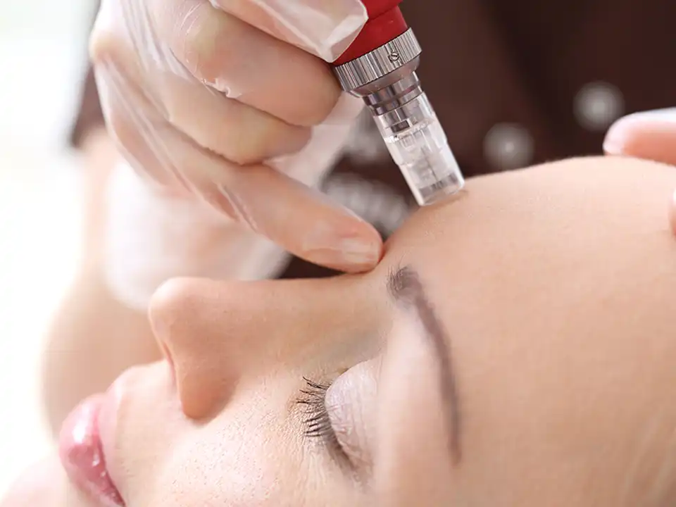 mesotherapy with plla second image