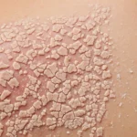 image Get a Flake-Free Back-1